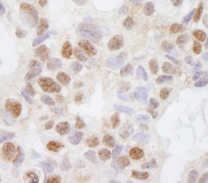 Detection of Human DHX38 by Immunohistochemistry. Sample: FFPE section of human breast carcinoma. Antibody: Affinity purified rabbit anti-DHX38 used at a dilution of 1:250.