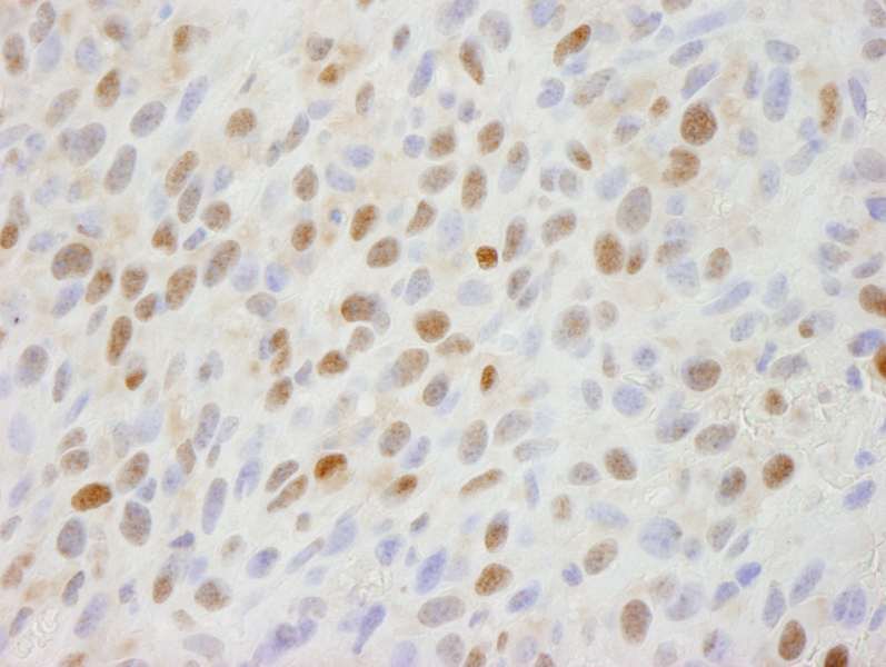 Detection of Mouse DHX8 by Immunohistochemistry. Sample: FFPE section of mouse squamous cell carcinoma. Antibody: Affinity purified rabbit anti-DHX8 used at a dilution of 1:100.