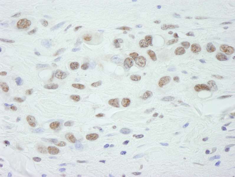 Detection of Human DHX8 by Immunohistochemistry. Sample: FFPE section of human gastric tumor. Antibody: Affinity purified rabbit anti-DHX8 used at a dilution of 1:500.