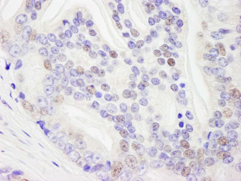 Detection of Human DHX9 by Immunohistochemistry. Sample: FFPE section of human prostate carcinoma. Antibody: Affinity purified rabbit anti-DHX9 used at a dilution of 1:1000 (0.2 ug/ml). Detection: DAB.