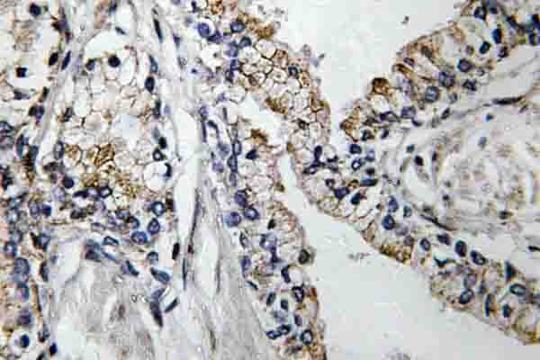 IHC of VDR (K45) pAb in paraffin-embedded human prostate carcinoma tissue.