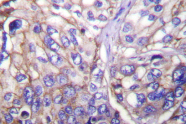 IHC of Claudin7 (P202) pAb in paraffin-embedded human lung carcinoma tissue.