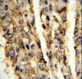 Formalin-fixed and paraffin-embedded human hepatocarcinoma reacted with DIO3 Antibody , which was peroxidase-conjugated to the secondary antibody, followed by DAB staining. This data demonstrates the use of this antibody for immunohistochemistry; clinical relevance has not been evaluated.