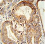 CLDN7 antibody immunohistochemistry of formalin-fixed and paraffin-embedded human prostate carcinoma followed by peroxidase-conjugated secondary antibody and DAB staining.