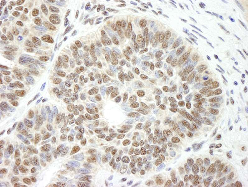 Detection of Human CCAR1 by Immunohistochemistry. Sample: FFPE section of human skin basal cell carcinoma. Antibody: Affinity purified rabbit anti-CCAR1 used at a dilution of 1:250. Detection: DAB staining using anti-Rabbit IHC antibody at a dilution of 1:100.