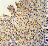 DI3L1 Antibody immunohistochemistry of formalin-fixed and paraffin-embedded human cervix carcinoma followed by peroxidase-conjugated secondary antibody and DAB staining.