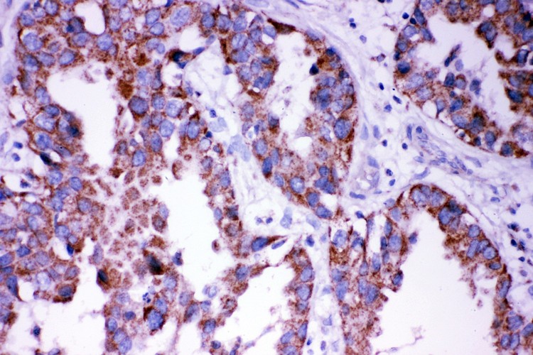 DISC1 antibody IHC-paraffin: Human Lung Cancer Tissue.