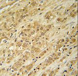 DKC1 Antibody immunohistochemistry of formalin-fixed and paraffin-embedded human prostate carcinoma followed by peroxidase-conjugated secondary antibody and DAB staining.