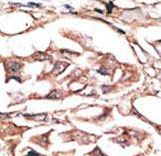 Formalin-fixed and paraffin-embedded human cancer tissue reacted with the primary antibody, which was peroxidase-conjugated to the secondary antibody, followed by AEC staining. This data demonstrates the use of this antibody for immunohistochemistry; clinical relevance has not been evaluated. BC = breast carcinoma; HC = hepatocarcinoma.