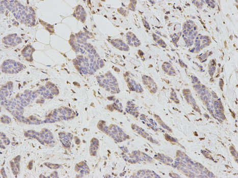 Immunohistochemistry of paraffin-embedded human breast cancer using DKK3 antibody at dilution of 1:100 (200x lens).