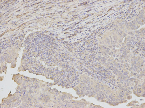 Immunohistochemistry of paraffin-embedded human endometrial cancer using DKK3 antibody at dilution of 1:100 (200x lens).