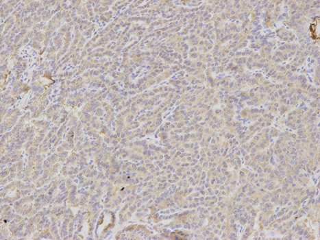 Immunohistochemistry of paraffin-embedded human thyroid cancer using DKK3 antibody at dilution of 1:100 (200x lens).