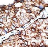 Formalin-fixed and paraffin-embedded human cancer tissue reacted with the primary antibody, which was peroxidase-conjugated to the secondary antibody, followed by DAB staining. This data demonstrates the use of this antibody for immunohistochemistry; clinical relevance has not been evaluated. BC = breast carcinoma; HC = hepatocarcinoma.
