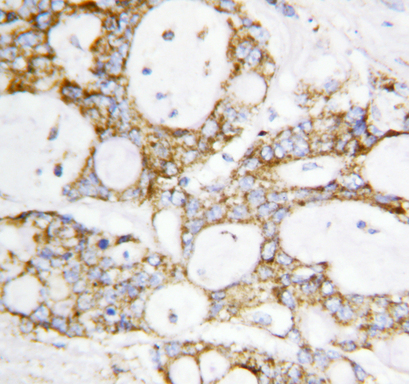 DLD / Diaphorase / E3 antibody. IHC(P): Human Breast Cancer Tissue.