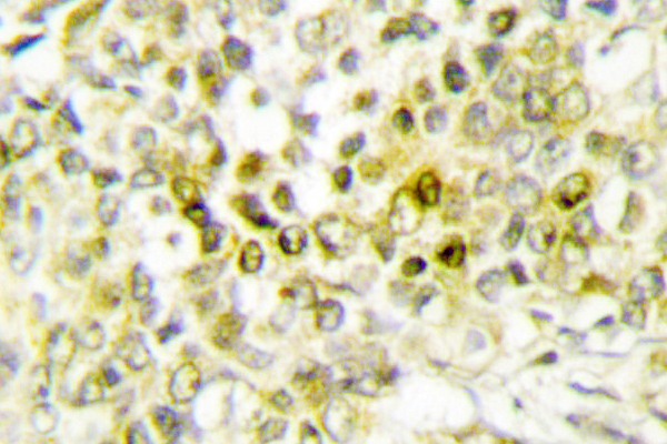 IHC of Dlx-5 (E126) pAb in paraffin-embedded human lung carcinoma tissue.