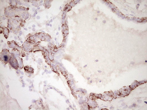 IHC of paraffin-embedded Adenocarcinoma of Human breast tissue using anti-SYNM mouse monoclonal antibody. (Heat-induced epitope retrieval by 1 mM EDTA in 10mM Tris, pH8.5, 120°C for 3min).