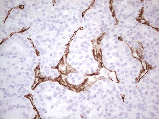 IHC of paraffin-embedded Carcinoma of Human thyroid tissue using anti-SYNM mouse monoclonal antibody. (Heat-induced epitope retrieval by 1 mM EDTA in 10mM Tris, pH8.5, 120°C for 3min).