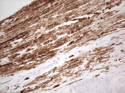 IHC of paraffin-embedded Adenocarcinoma of Human colon tissue using anti-SYNM mouse monoclonal antibody. (Heat-induced epitope retrieval by 1 mM EDTA in 10mM Tris, pH8.5, 120°C for 3min).