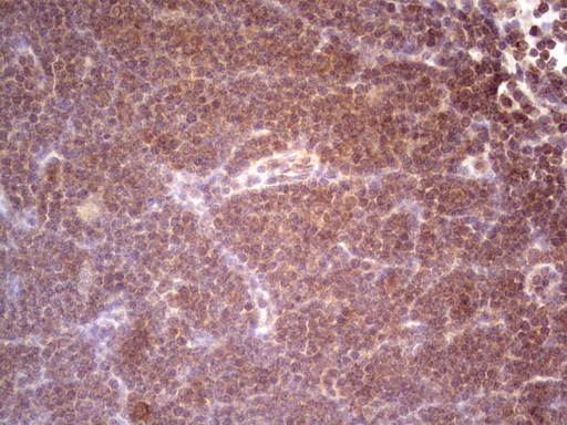 IHC of paraffin-embedded Human lymphoma tissue using anti-SYNM mouse monoclonal antibody. (heat-induced epitope retrieval by 1 mM EDTA in 10mM Tris, pH8.5, 120°C for 3min).
