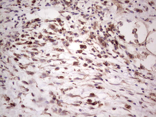IHC of paraffin-embedded Carcinoma of Human pancreas tissue using anti-SYNM mouse monoclonal antibody. (heat-induced epitope retrieval by 1 mM EDTA in 10mM Tris, pH8.5, 120°C for 3min).