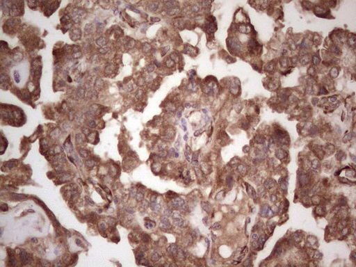 IHC of paraffin-embedded Adenocarcinoma of Human ovary tissue using anti-SYNM mouse monoclonal antibody. (heat-induced epitope retrieval by 1 mM EDTA in 10mM Tris, pH8.5, 120°C for 3min).