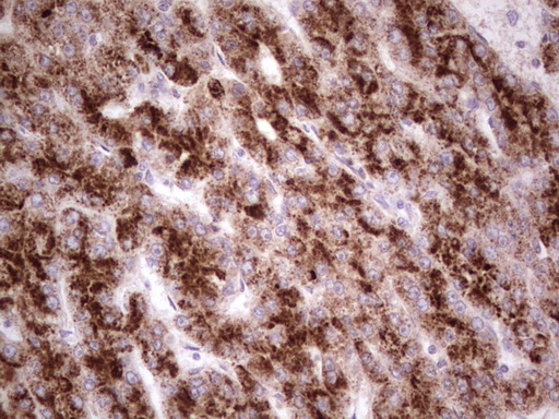 IHC of paraffin-embedded Carcinoma of Human liver tissue using anti-SYNM mouse monoclonal antibody. (heat-induced epitope retrieval by 1 mM EDTA in 10mM Tris, pH8.5, 120°C for 3min).