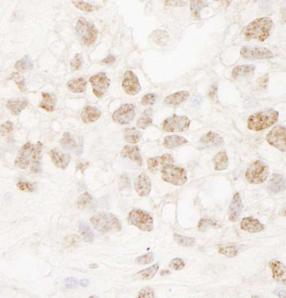Detection of Human DMWD by Immunohistochemistry. Sample: FFPE section of human breast carcinoma. Antibody: Affinity purified rabbit anti-DMWD used at a dilution of 1:250.