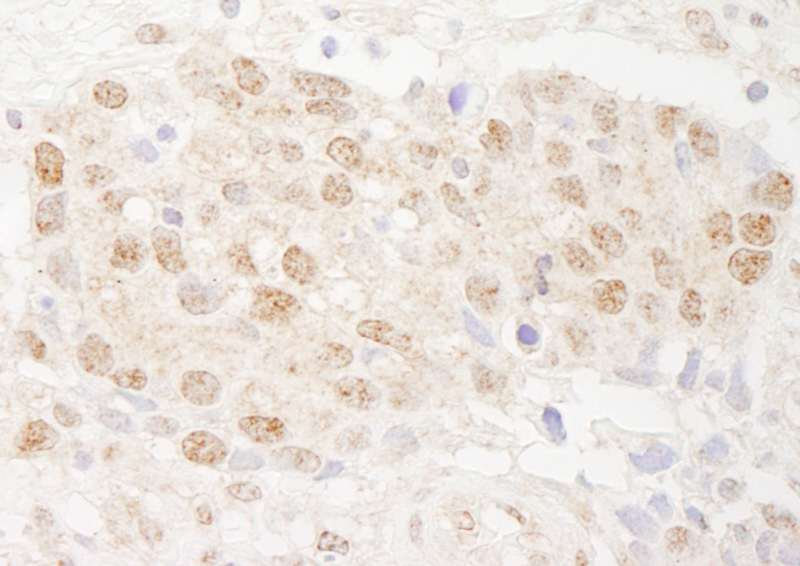 Detection of Human DMWD by Immunohistochemistry. Sample: FFPE section of human breast carcinoma. Antibody: Affinity purified rabbit anti-DMWD used at a dilution of 1:1000 (1 ug/ml). Detection: DAB.