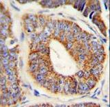 DNAJA1 Antibody immunohistochemistry of formalin-fixed and paraffin-embedded human prostate carcinoma followed by peroxidase-conjugated secondary antibody and DAB staining.