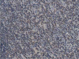 IHC of paraffin-embedded Human lymphoma tissue using anti-DNAJA2 mouse monoclonal antibody. (Dilution 1:50).