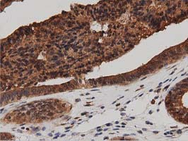 IHC of paraffin-embedded Adenocarcinoma of Human endometrium tissue using anti-DNAJA2 mouse monoclonal antibody. (Dilution 1:50).