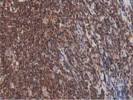 IHC of paraffin-embedded Human lymphoma tissue using anti-DNAJA2 mouse monoclonal antibody. (Dilution 1:50).
