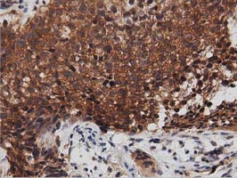 IHC of paraffin-embedded Carcinoma of Human bladder tissue using anti-DNAJA2 mouse monoclonal antibody. (Dilution 1:50).