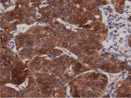 IHC of paraffin-embedded Adenocarcinoma of Human ovary tissue using anti-DNAJA2 mouse monoclonal antibody. (Dilution 1:50).