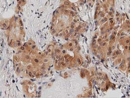 IHC of paraffin-embedded Carcinoma of Human thyroid tissue using anti-DNAJA2 mouse monoclonal antibody. (Dilution 1:50).