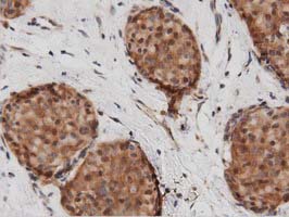 IHC of paraffin-embedded Adenocarcinoma of Human breast tissue using anti-DNAJA2 mouse monoclonal antibody. (Dilution 1:50).