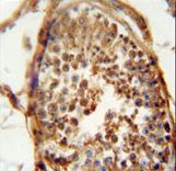 DNAJB13 antibody immunohistochemistry of formalin-fixed and paraffin-embedded human testis carcinoma followed by peroxidase-conjugated secondary antibody and DAB staining.