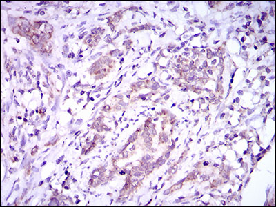 IHC of paraffin-embedded cervical cancer tissues using DNAL4 mouse monoclonal antibody with DAB staining.