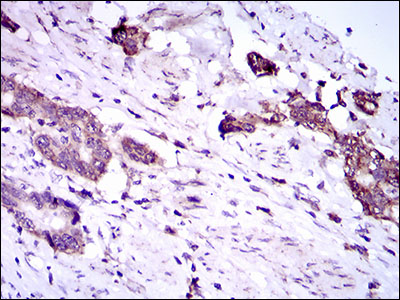 IHC of paraffin-embedded esophageal cancer tissues using DNAL4 mouse monoclonal antibody with DAB staining.