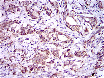 IHC of paraffin-embedded cervical cancer tissues using DNAL4 mouse monoclonal antibody with DAB staining.