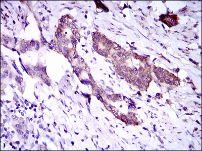IHC of paraffin-embedded esophageal cancer tissues using DNAL4 mouse monoclonal antibody with DAB staining.