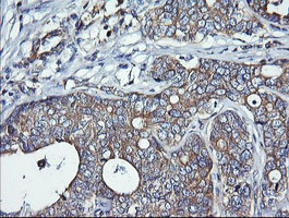 IHC of paraffin-embedded Adenocarcinoma of Human breast tissue using anti-DNM1L mouse monoclonal antibody. (Heat-induced epitope retrieval by 10mM citric buffer, pH6.0, 120°C for 3min).