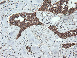 IHC of paraffin-embedded Carcinoma of Human bladder tissue using anti-DNM1L mouse monoclonal antibody.