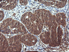 IHC of paraffin-embedded Adenocarcinoma of Human ovary tissue using anti-DNM1L mouse monoclonal antibody.