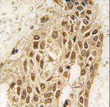 Formalin-fixed and paraffin-embedded human lung carcinoma tissue reacted with Dnmt3a antibody (N-term R46) , which was peroxidase-conjugated to the secondary antibody, followed by DAB staining. This data demonstrates the use of this antibody for immunohistochemistry; clinical relevance has not been evaluated.