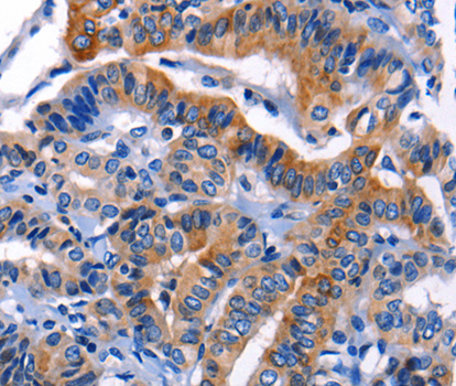 Immunohistochemistry of paraffin-embedded human thyroid cancer tissue, using CHI3L1 antibody.