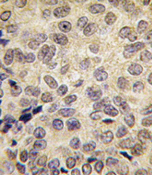 Formalin-fixed and paraffin-embedded human prostate carcinoma tissue reacted with Dnmt3b antibody , which was peroxidase-conjugated to the secondary antibody, followed by DAB staining. This data demonstrates the use of this antibody for immunohistochemistry; clinical relevance has not been evaluated.