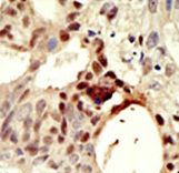 Formalin-fixed and paraffin-embedded human cancer tissue reacted with the primary antibody, which was peroxidase-conjugated to the secondary antibody, followed by DAB staining. This data demonstrates the use of this antibody for immunohistochemistry; clinical relevance has not been evaluated. BC = breast carcinoma; HC = hepatocarcinoma.