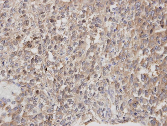 IHC of paraffin-embedded Lung CA using DOCK 180 antibody at 1:100 dilution.