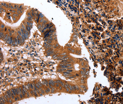Immunohistochemistry of paraffin-embedded human colon cancer tissue using CLEC4A antibody.